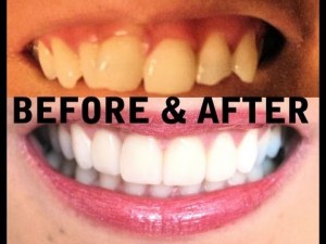 before and after of teeth